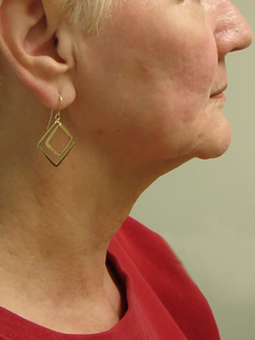 Facelift | Neck Lift Before and After case 1