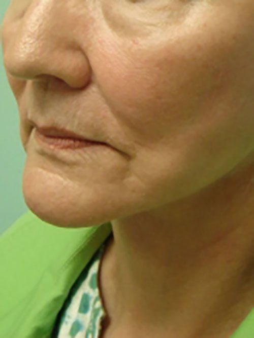 Facelift | Neck Lift Before and After case 1