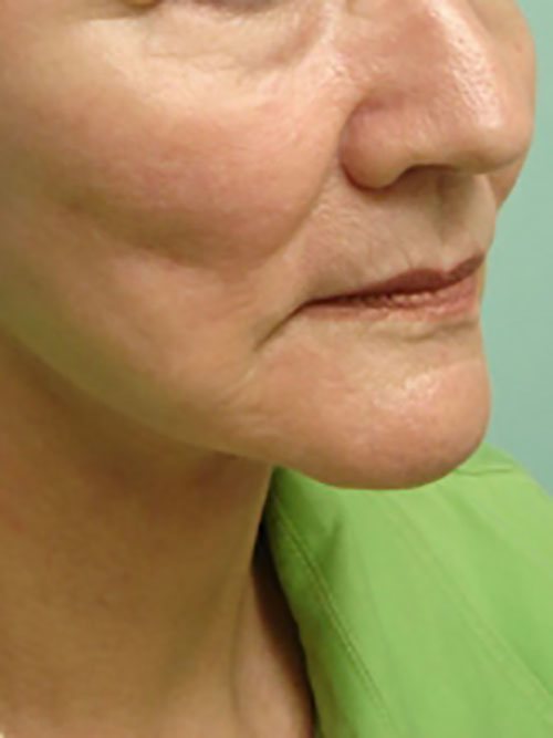 Facelift | Neck Lift Before and After case 1