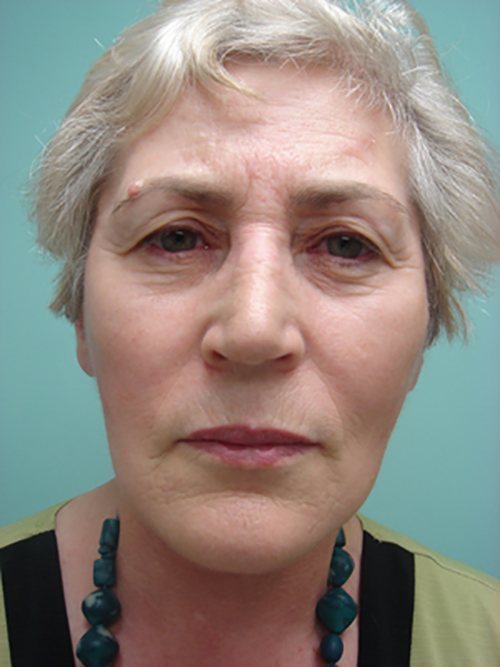 Facelift | Neck Lift Before and After case 2