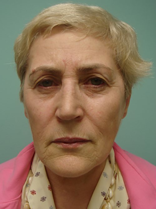 Facelift | Neck Lift Before and After case 2