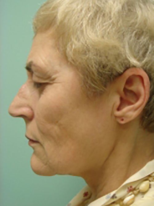 Facelift | Neck Lift Before and After case 2