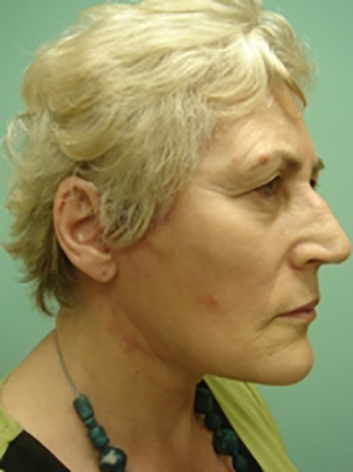 Facelift | Neck Lift Before and After case 2