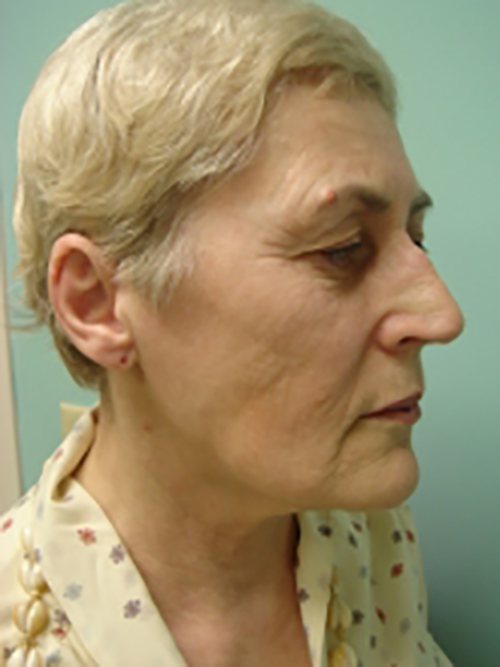 Facelift | Neck Lift Before and After case 2