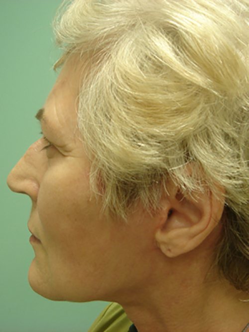 Facelift | Neck Lift Before and After case 2