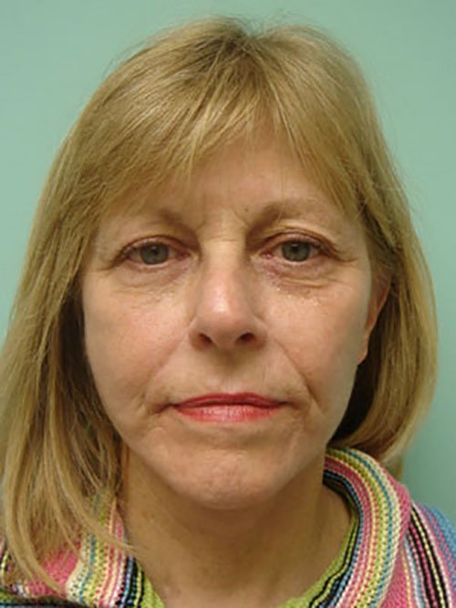 Facelift | Neck Lift Before and After case 3