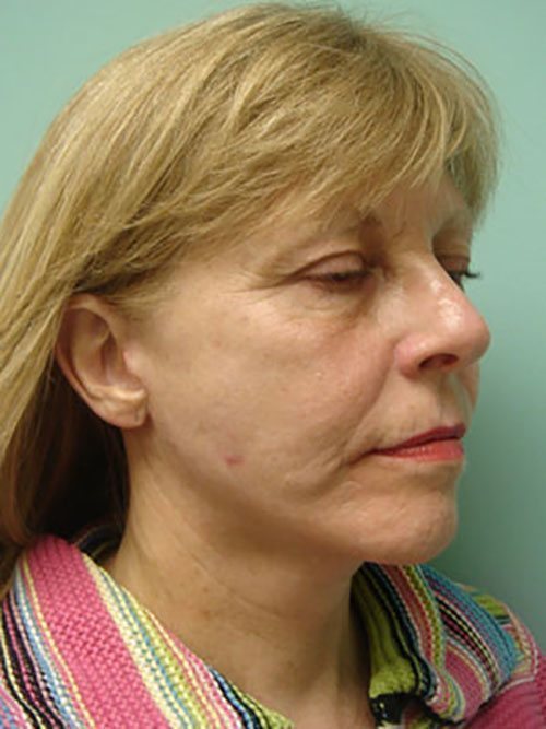 Facelift | Neck Lift Before and After case 3