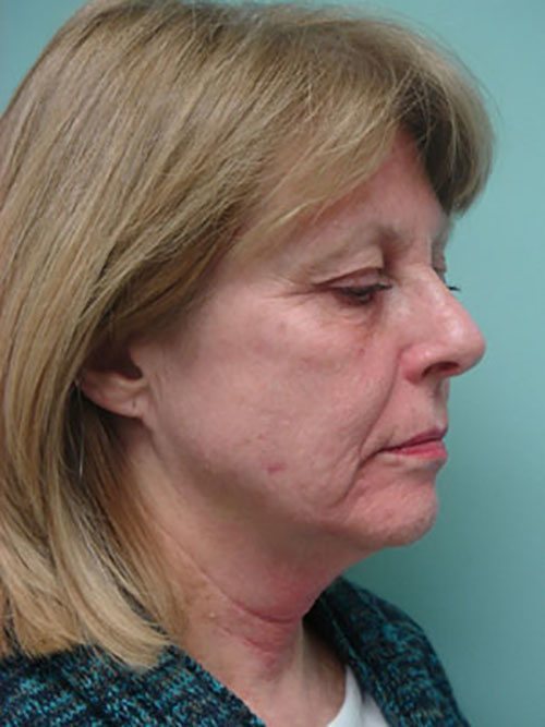 Facelift | Neck Lift Before and After case 3