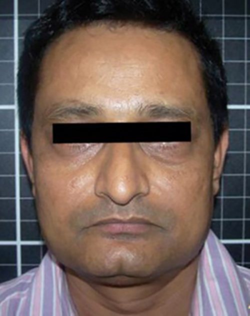 Facial Rejuvenation Before & After case 1