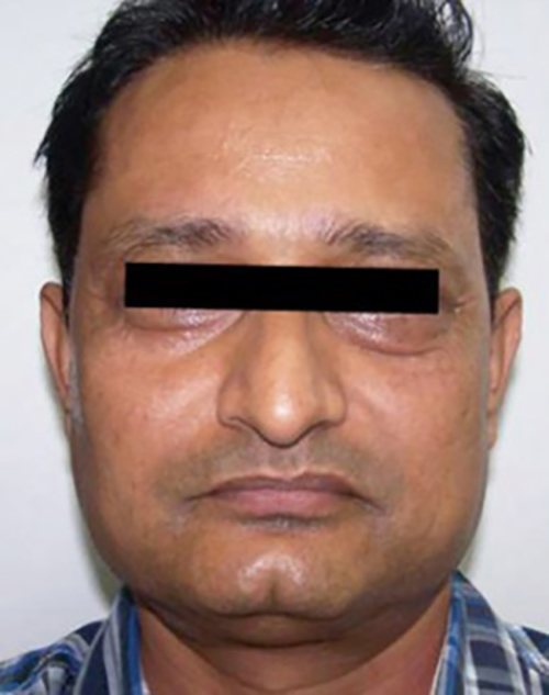 Facial Rejuvenation Before & After case 1