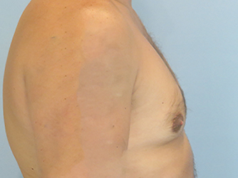 Gynecomastia Before & After