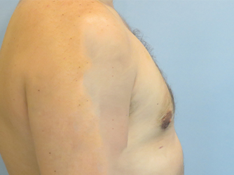 Gynecomastia Before & After case 8