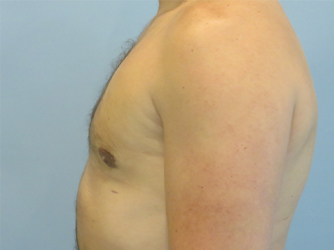 Gynecomastia Before & After case 8