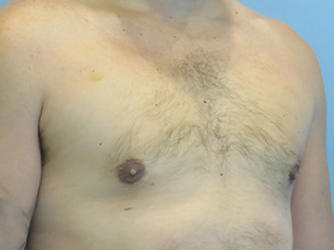 Gynecomastia Before & After case 8