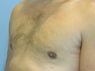 Gynecomastia Before & After case 8