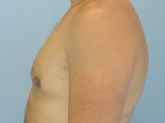 Gynecomastia Before & After case 8