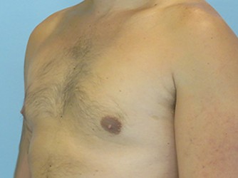Gynecomastia Before & After case 8