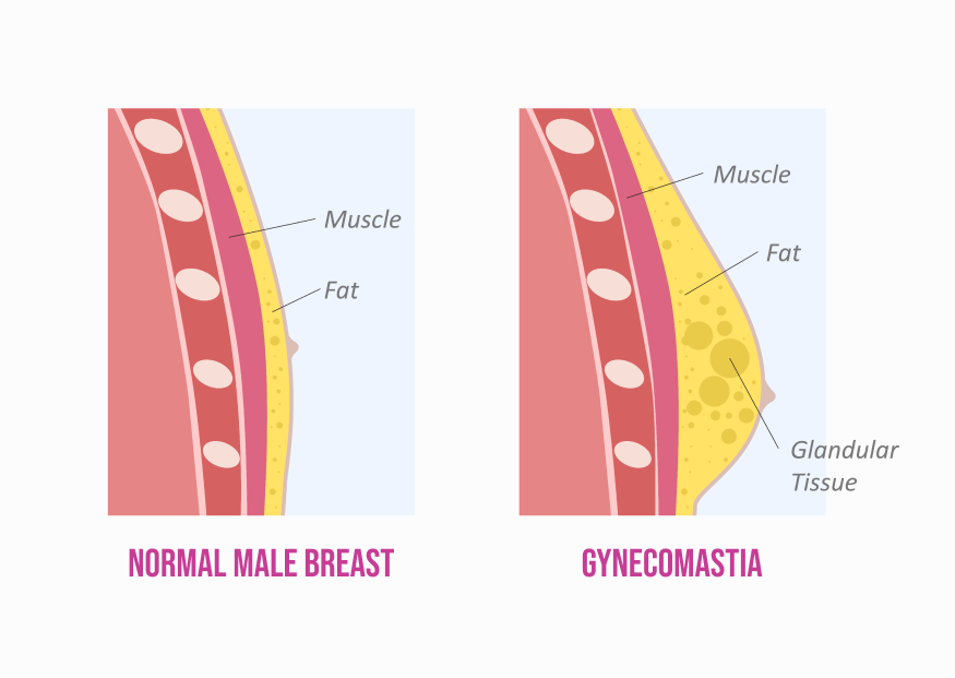 Gynecomastia Explained
