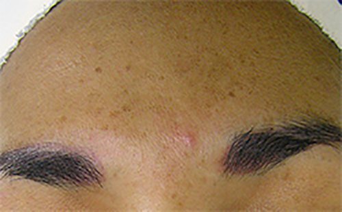 Hydrafacial Before & After case 1