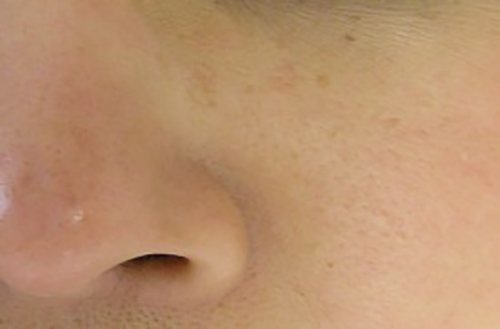 Hydrafacial Before & After case 2