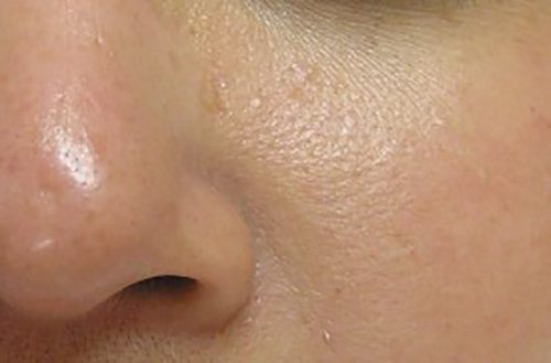 Hydrafacial Before & After case 2
