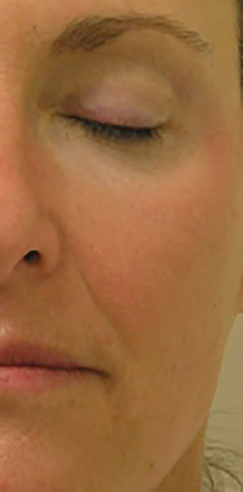 Hydrafacial Before & After case 3
