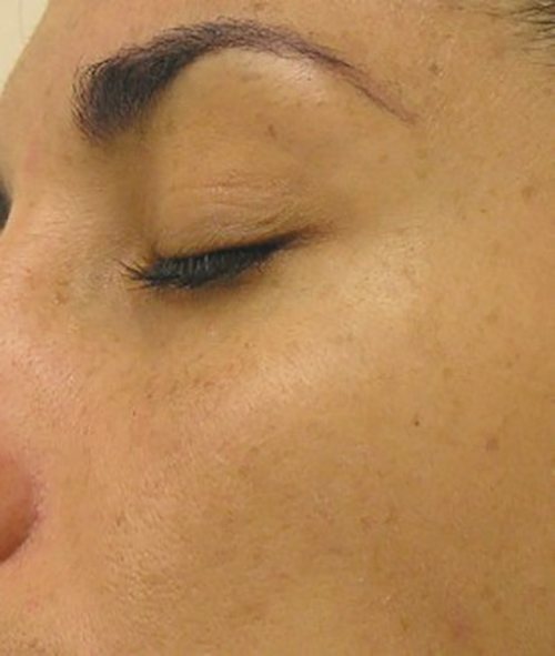 Hydrafacial Before & After case 5