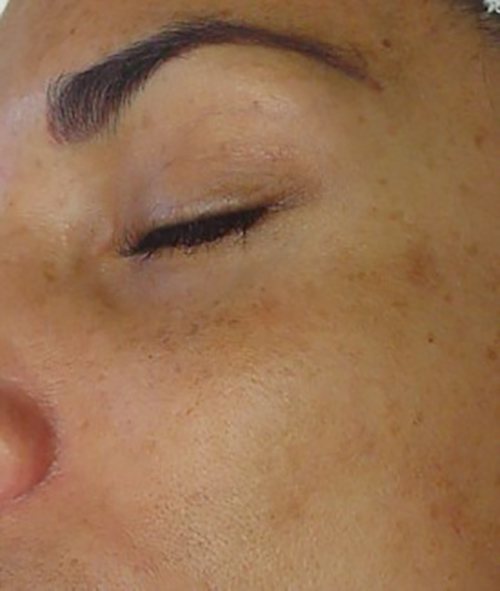 Hydrafacial Before & After case 5