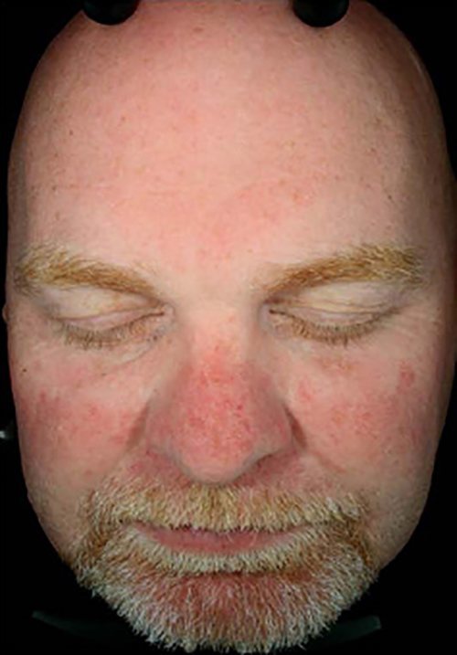 Hydrafacial Before & After case 6