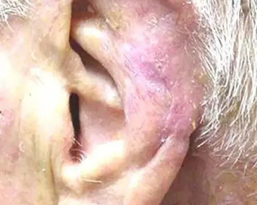 Skin Cancer Before & After case 1