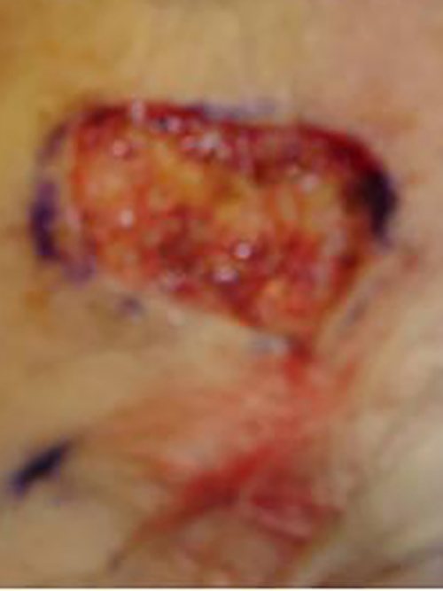 Skin Cancer Before & After case 1
