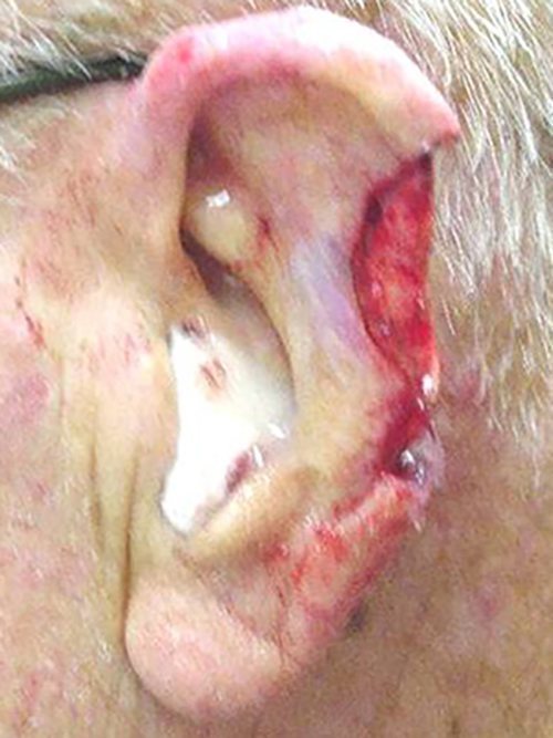 Skin Cancer Before & After case 3