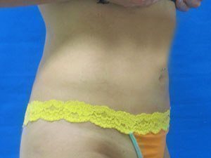 Smart Liposuction Before & After case 10