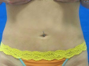 Smart Liposuction Before & After case 10