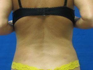 Smart Liposuction Before & After case 10