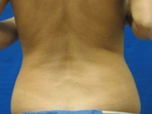 Smart Liposuction Before & After case 10