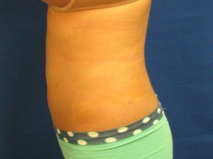 Smart Liposuction Before & After case 11