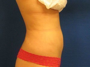 Smart Liposuction Before & After case 11