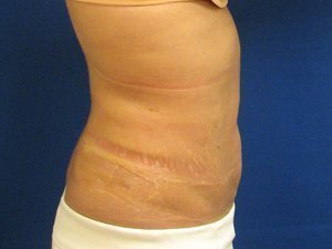 Smart Liposuction Before & After case 12