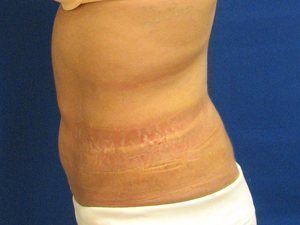Smart Liposuction Before & After case 12