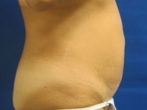 Smart Liposuction Before & After case 13