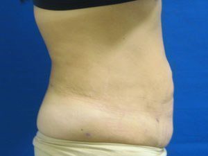 Smart Liposuction Before & After case 13