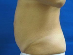 Smart Liposuction Before & After case 13