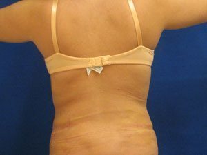 Smart Liposuction Before & After case 14