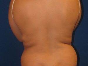 Smart Liposuction Before & After case 14