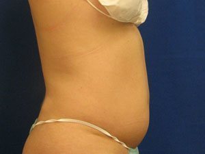 Smart Liposuction Before & After case 15