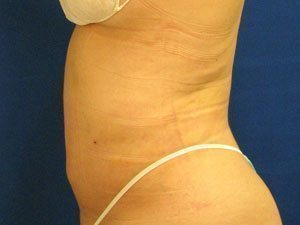 Smart Liposuction Before & After case 15