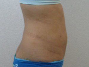 Smart Liposuction Before & After case 16