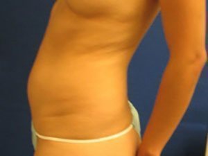 Smart Liposuction Before & After case 16