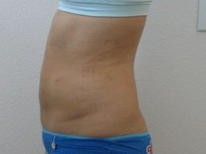 Smart Liposuction Before & After case 16